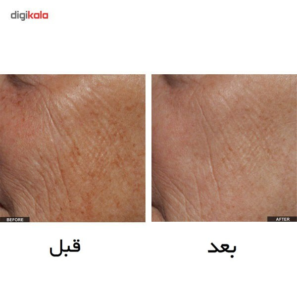 لیزر جوان سازی تریا مدل Age Defying