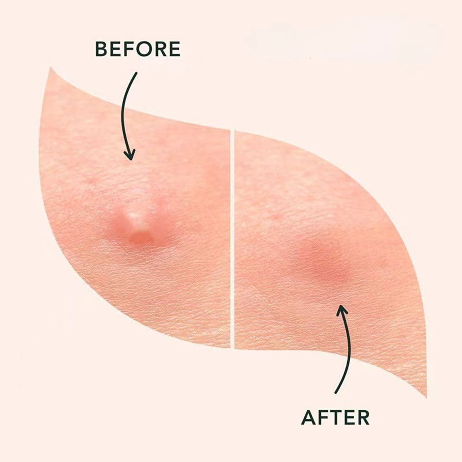 چسب ضد جوش پنرول مدل PRD Acne Cover Patch 360 بسته 36 عددی -  - 13