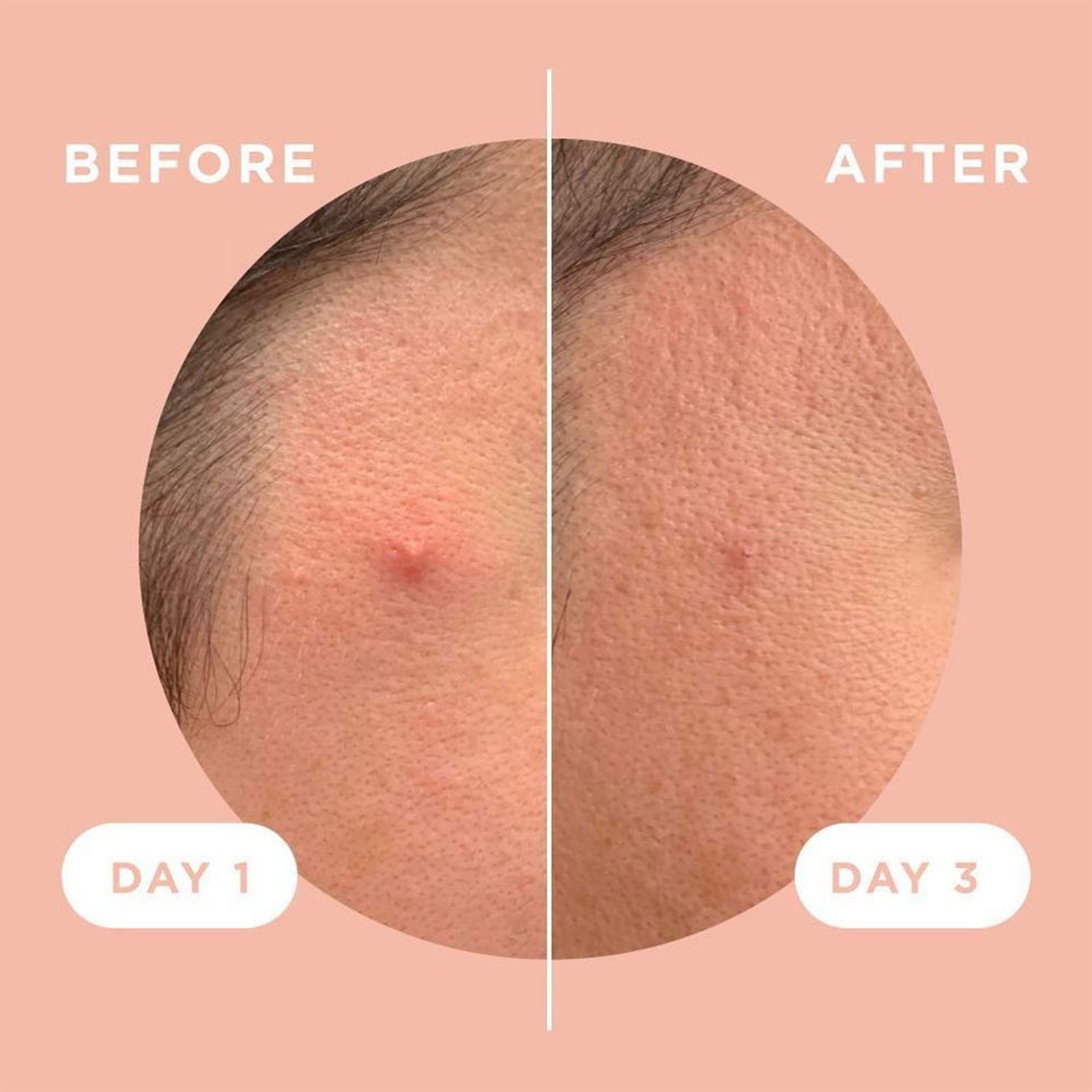 چسب ضد جوش پنرول مدل PRD Acne Cover Patch 360 بسته 36 عددی -  - 3