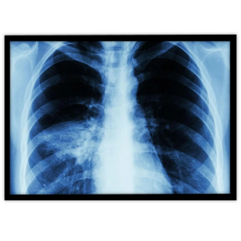 تابلو بکلیت طرح رادیوگرافی قفسه سینه مدل B-10627