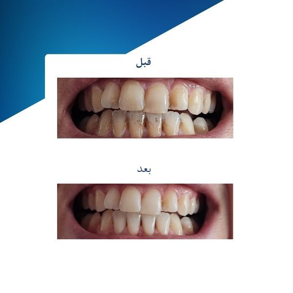 ژل سفید کننده دندان فاردنتو مدل TSR وزن 20 گرم مجموعه دو عددی -  - 3