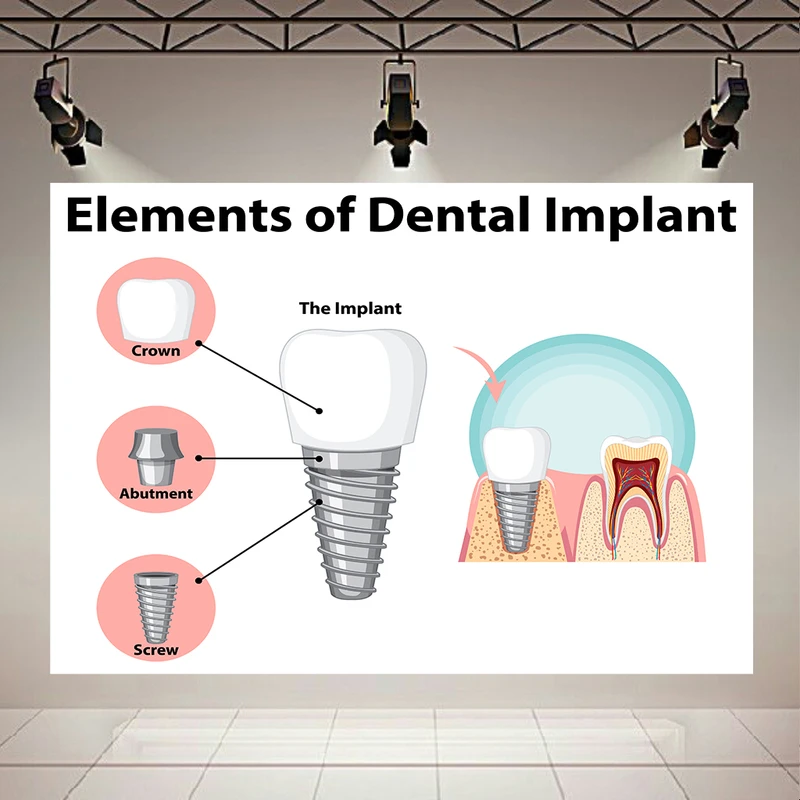 تابلو بوم طرح مخمل ساختار ایمپلنت مدل دندان کد AR305532