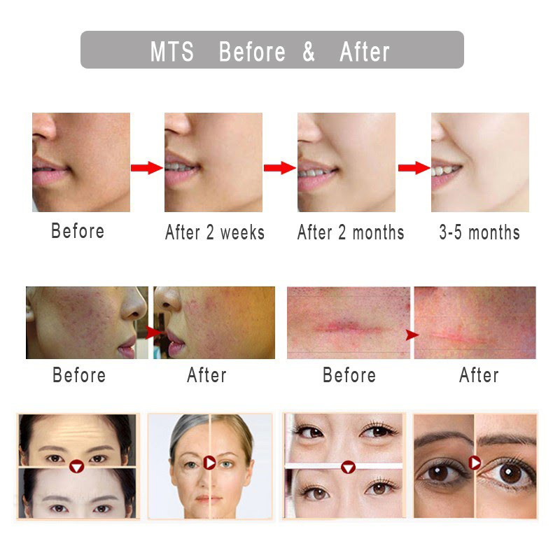 دستگاه میکرونیدلینگ هیدرانیدل مدل 20NEEDLESS1MM دستگاه میکرونیدلینگ هیدرانیدل مدل 20NEEDLESS1MM
