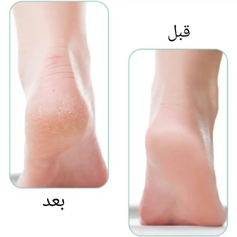 سوهان پا مدل نانو کریستالی