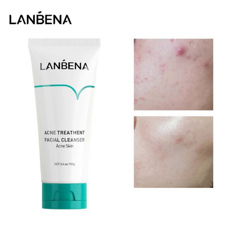 ژل ضد جوش لنبنا مدل چای سبز وزن 20 گرم