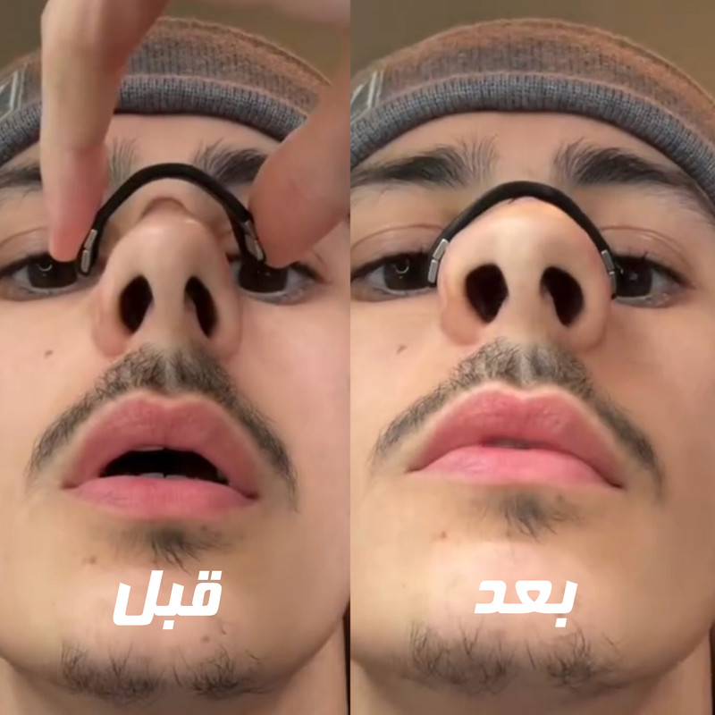 گیره رفع خروپف مدل Starter مجموعه 4 عددی به همراه چسب بینی بسته 3 عددی