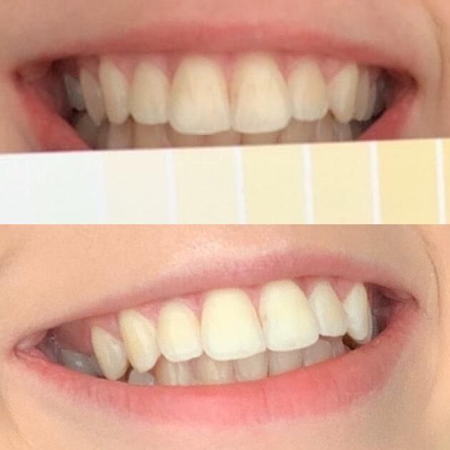 دستگاه سفید کننده دندان های اسمایل مدل 2022 - - 6