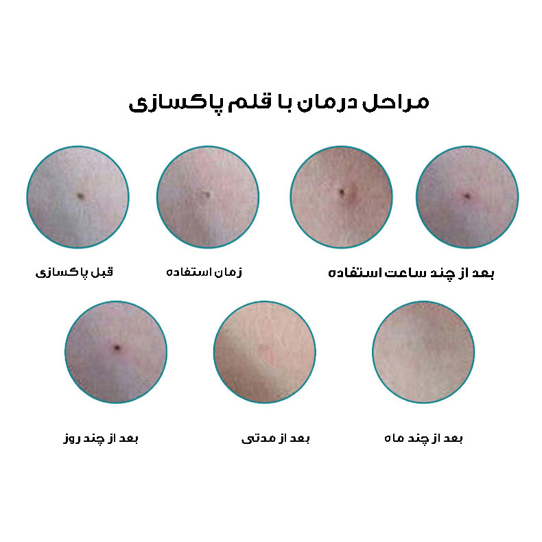 قلم پاک سازی پوست مدل دیجیتالی کد 9 سطح قلم پاک سازی پوست مدل دیجیتالی کد 9 سطح