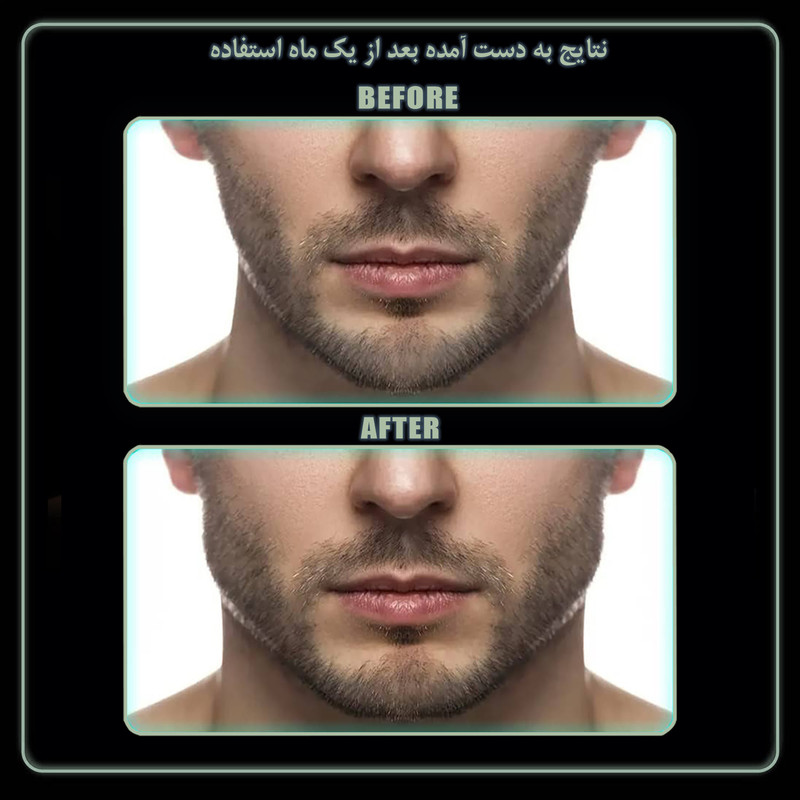 دستگاه زاویه ساز فک رادیس فیت مدل 3Levels 3W بسته 6 عددی