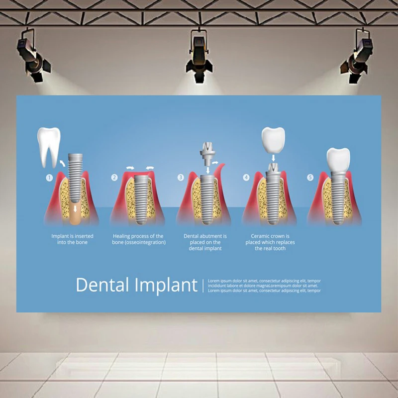 کاغذ دیواری مدل ایمپلنت دندان های انسان کد AR305577