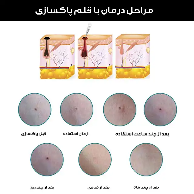 قلم پاک سازی پوست کد ZM-604