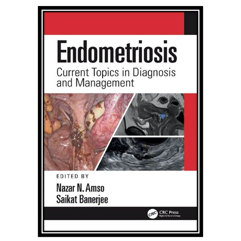 کتاب Endometriosis: Current Topics in Diagnosis and Management اثر Nazar Amso and Saikat Banerjee انتشارات مؤلفین طلایی