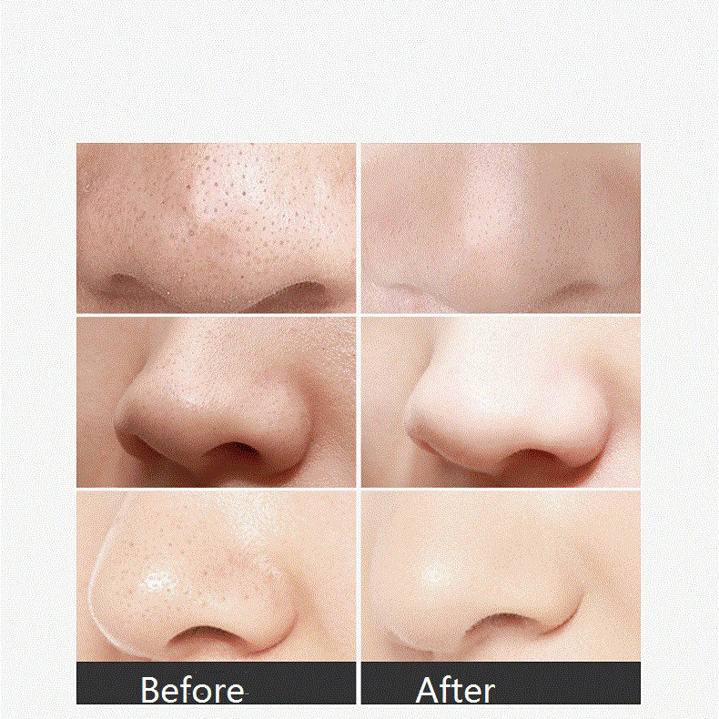 میکرودرم خانگی مدل MP503