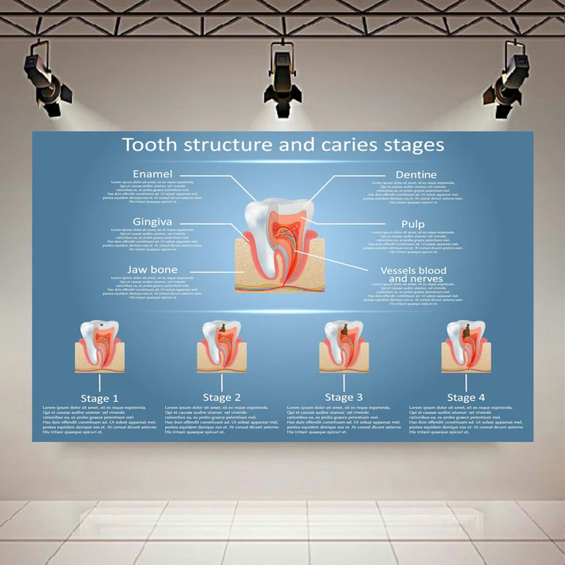 تابلو بوم طرح مخمل ساختار دندان مدل مراحل پوسیدگی کد AR305533