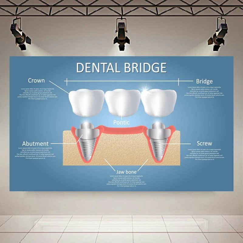 تابلو بوم طرح مخمل پل دندانی مدل آموزشی پزشکی و اینفوگرافیک کد AR305519