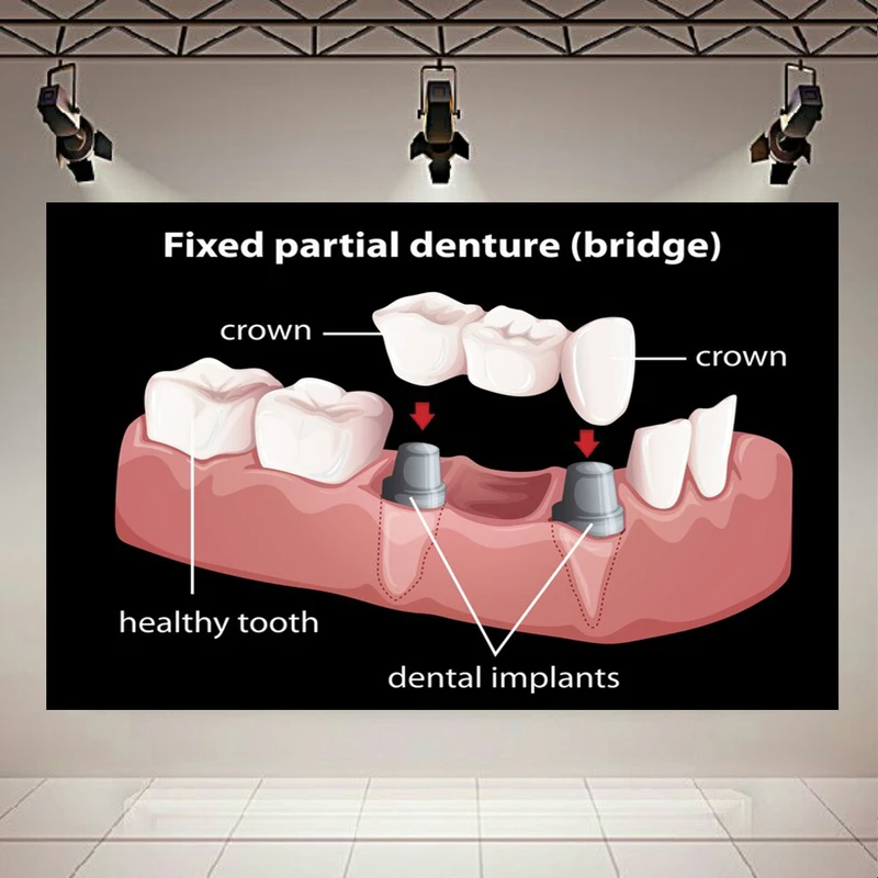 تابلو بوم طرح مخمل دندان مصنوعی مدل دندانپزشکی کد AR305526
