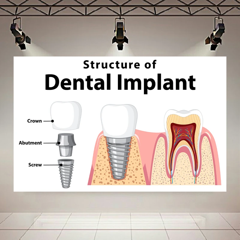 تابلو بوم طرح مخمل دندان پزشکی مدل ساختار ایمپنت دندان کد AR305524