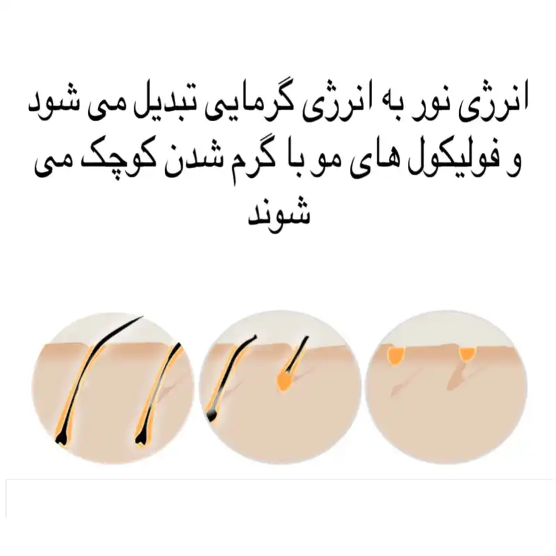 لیزر موهای زائد مدل PHOTON