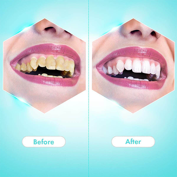 دستگاه سفید کننده دندان مدل de-2