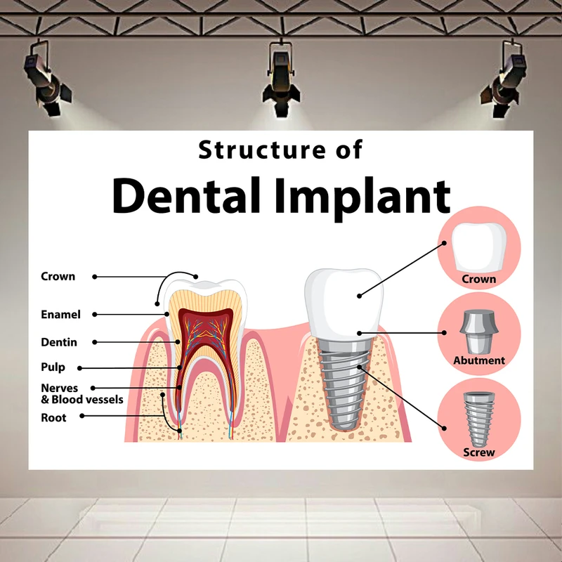 کاغذ دیواری مدل دندانپزشکی ساختار ایمپلنت دندان کد AR305593