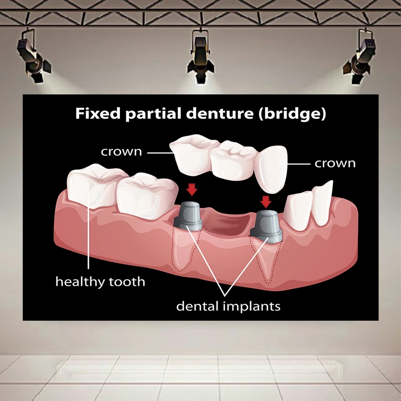  پوستر طرح بک لایت دندان مدل پل دندانی کد AR305736