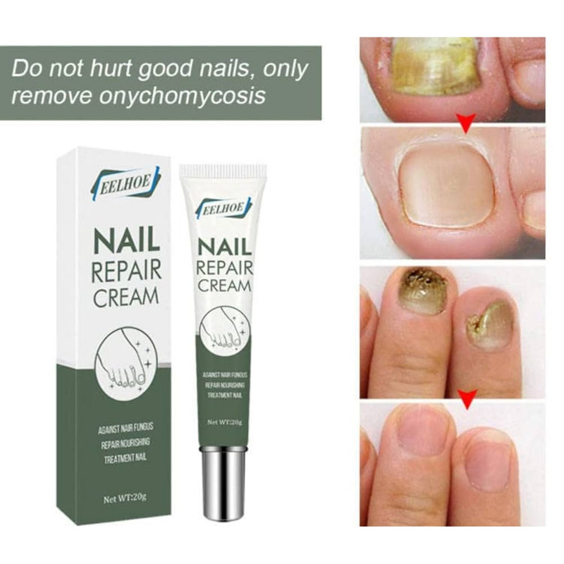 کرم تقویت کننده و ترمیم کننده ناخن ایلهو مدل ضدقارچ وزن 20 گرم