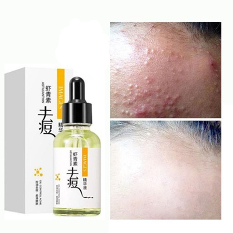 سرم ضد جوش ایمجز مدل ASTAXANTHIN حجم 30 میلی لیتر