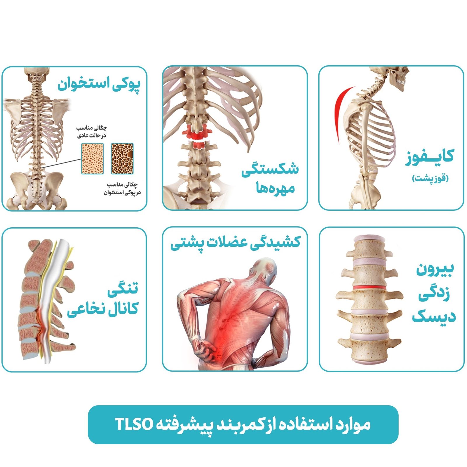 کمربند طبی اورتینو مدل TLSO -  - 3