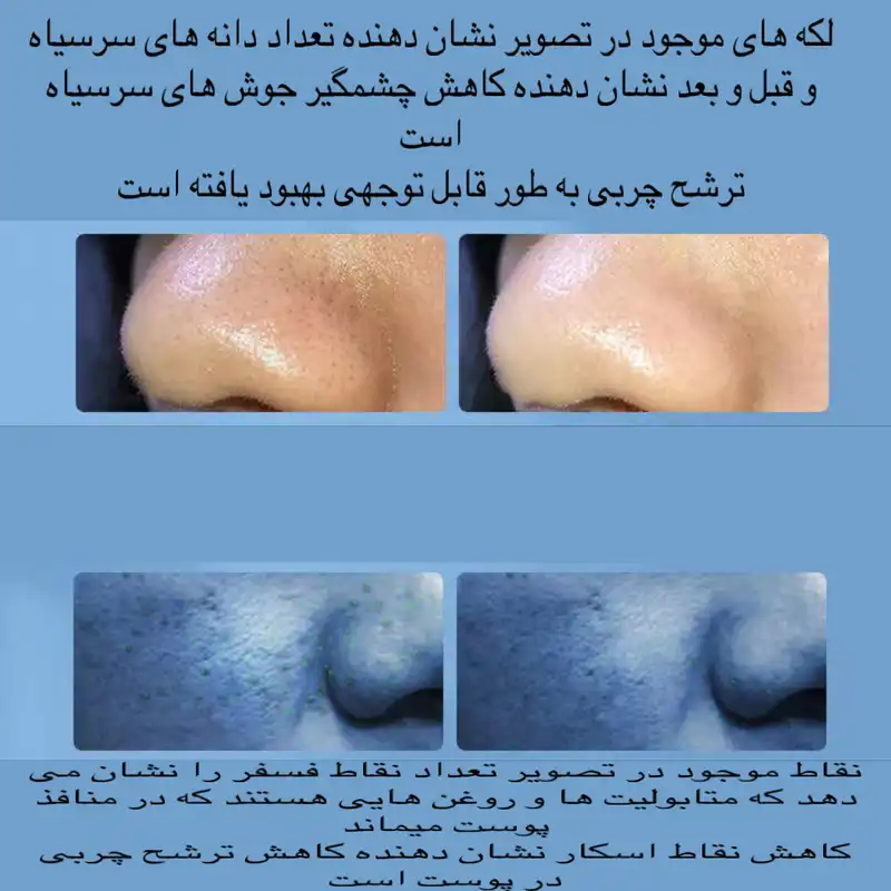 میکرودرم خانگی مدل Super Micro Bubble