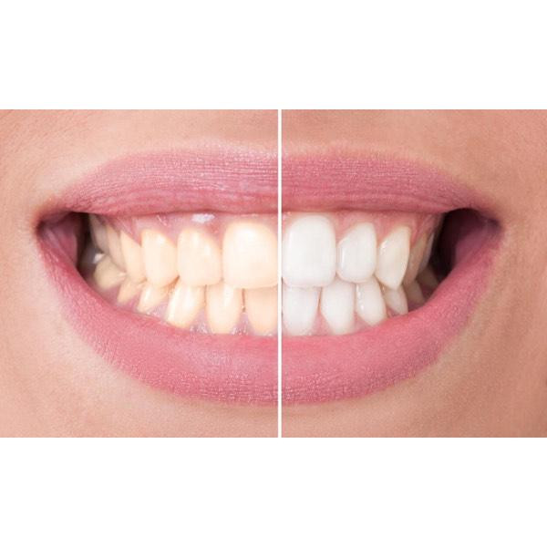 دستگاه سفید کننده دندان مدل DENTAL 360