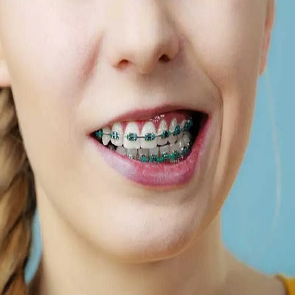 موم ارتودنسی آمیدن مدل Rxt حجم 3 میلی لیتر موم ارتودنسی آمیدن مدل Rxt حجم 3 میلی لیتر