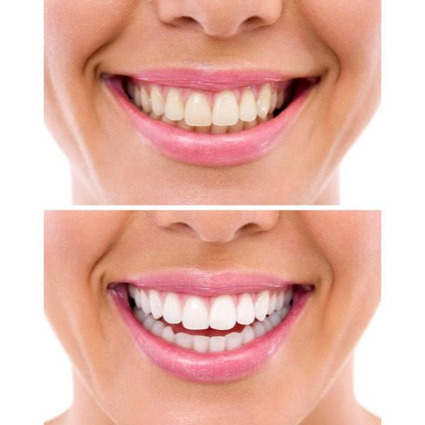 دستگاه سفید کننده دندان مدل DENTAL 360