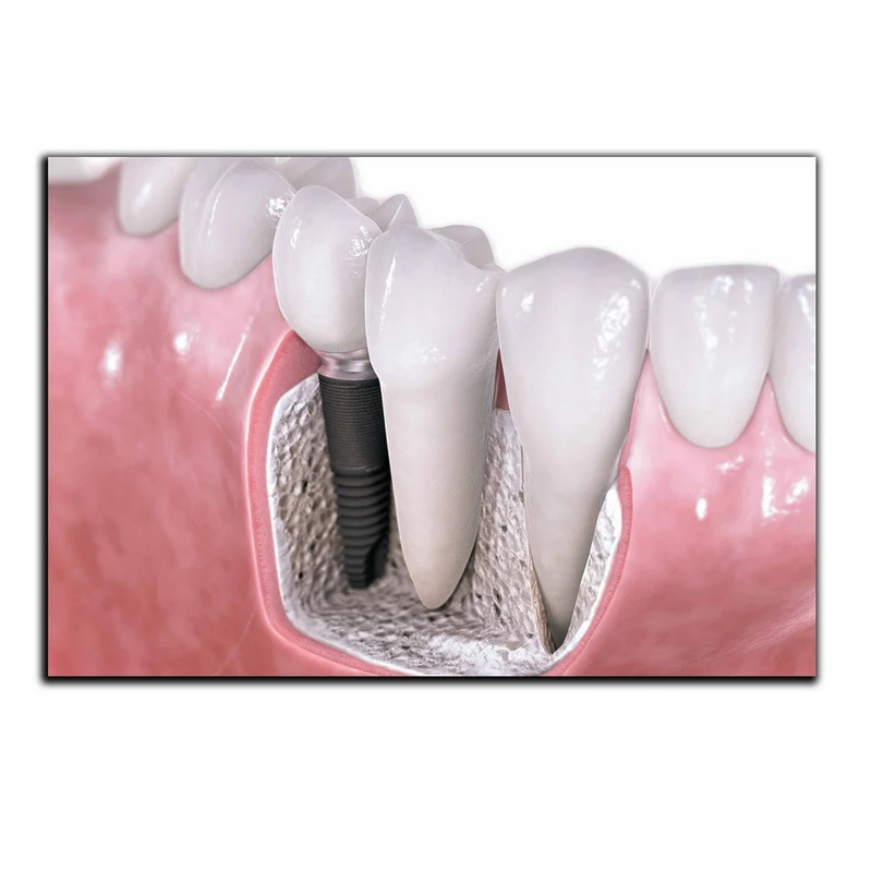 تابلو شاسی بکلیت طرح پوسیدگی دندان و دندانپزشکی مدل SH-2044