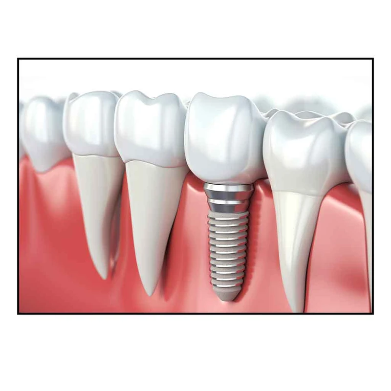 فرش پارچه‌ای مدل فرشینه طرح ایمپلنت دندان کد AR3061456