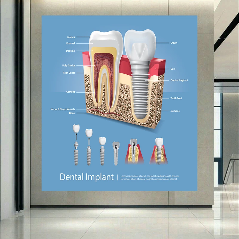 کاغذ دیواری طرح علمی دندانپزشکی مدل ایمپلنت دندان کد AR304015