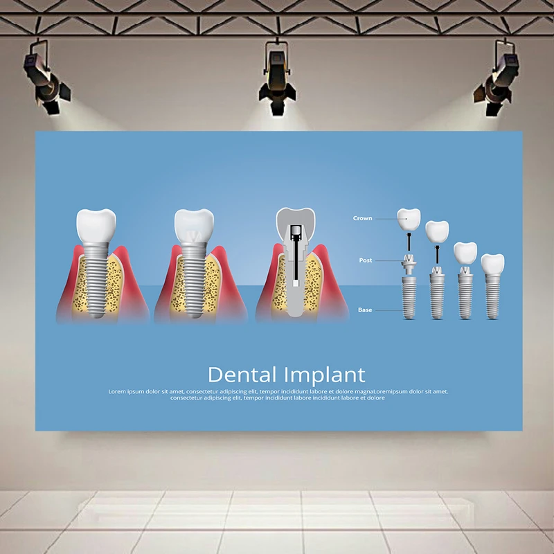 کاغذ دیواری مدل دندانپزشکی ایمپلنت دندان کد AR305591